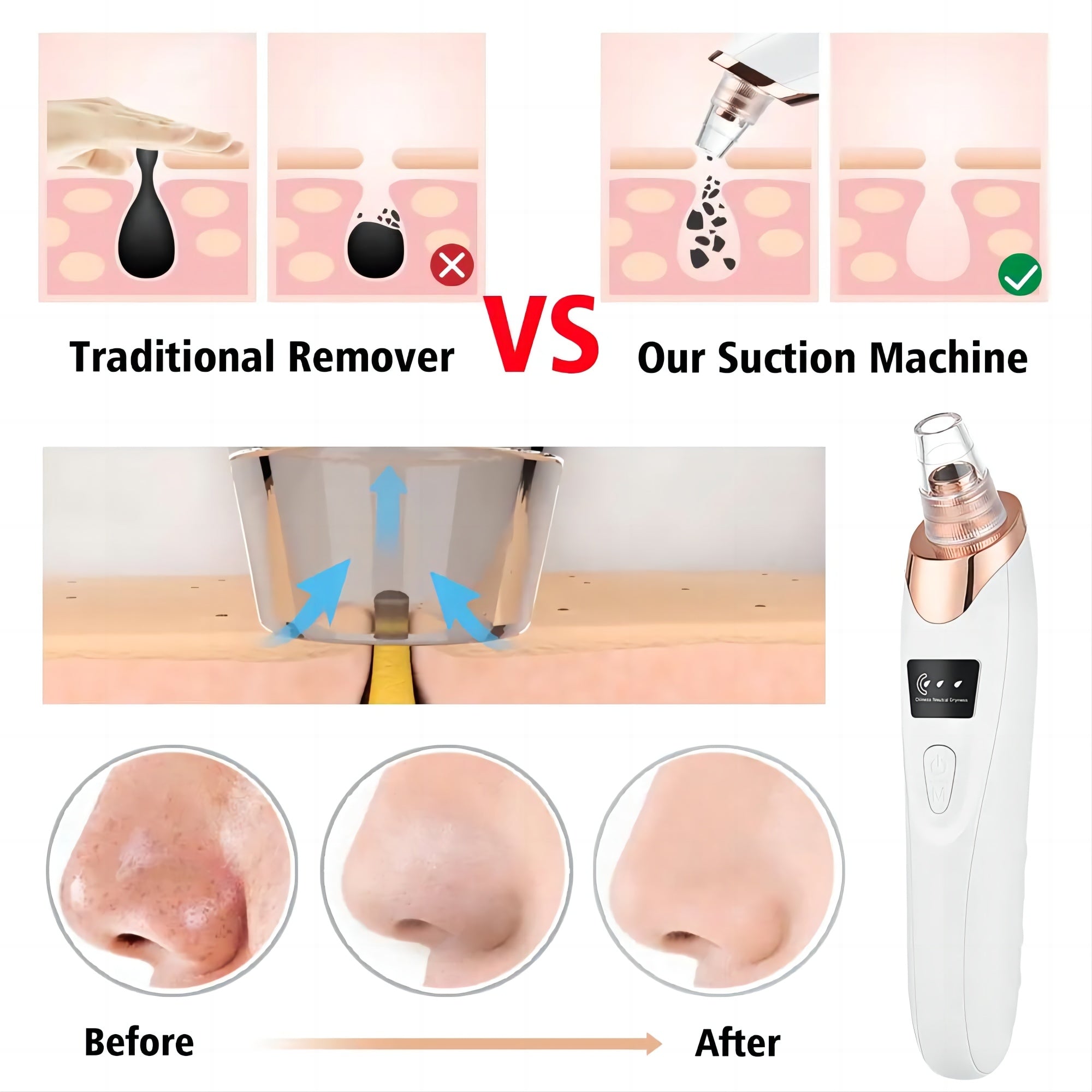 Newest Technology Blackhead Remover Vacuum Pore Cleaner for Face&Nose